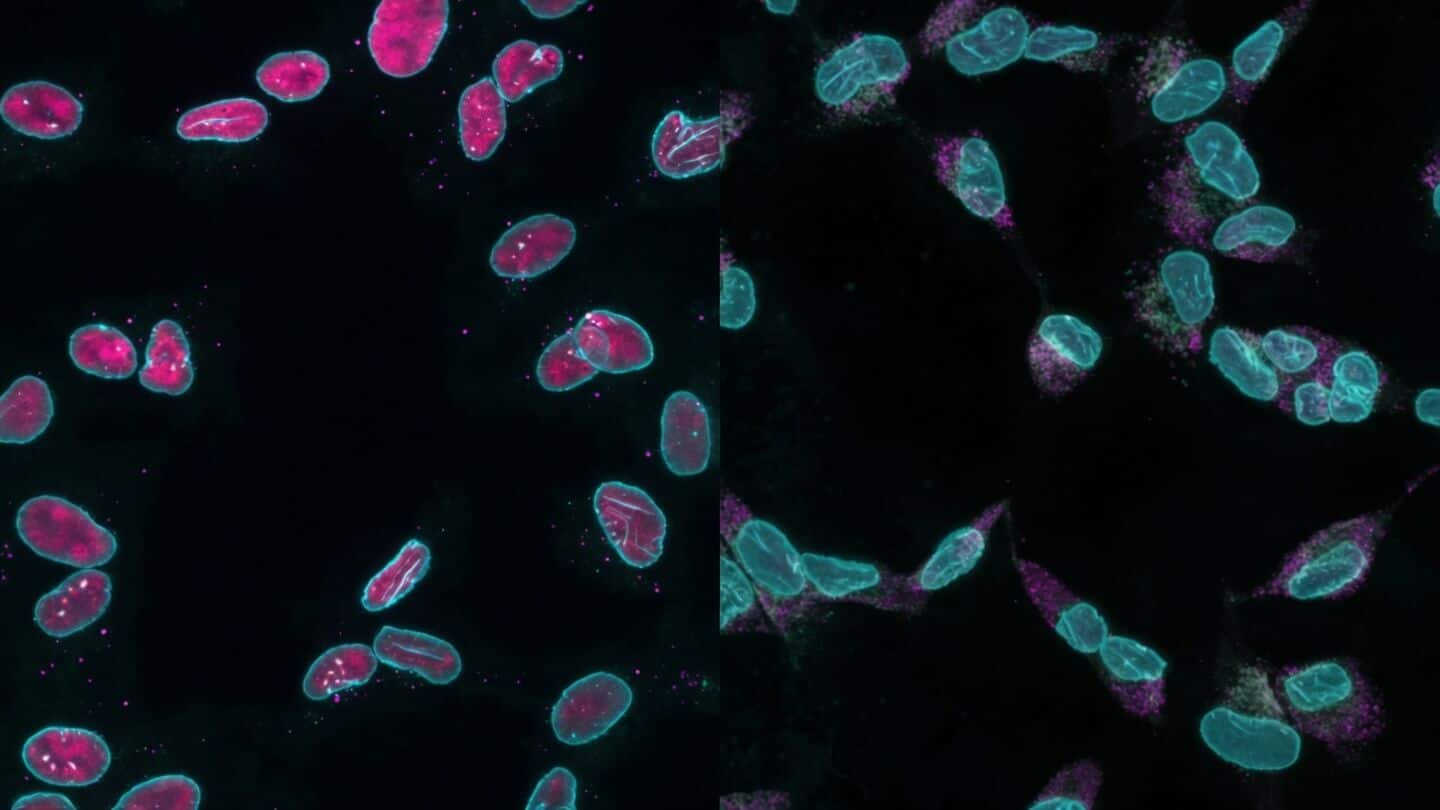 King's College London finds karyoptosis linked to dementia neuron loss
