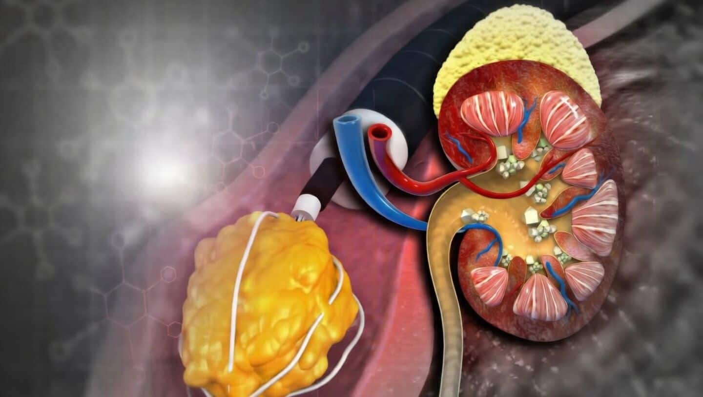 Kidney International study finds promising oral drug for PH2