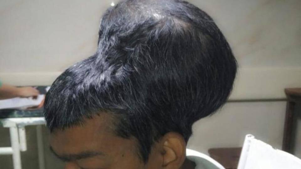 Mumbai: World's largest 1.8-kg tumor removed from man's brain