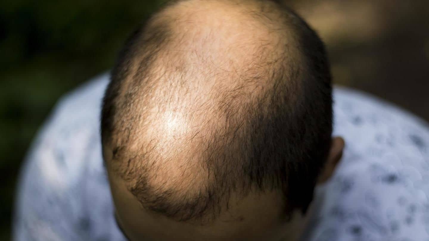 Bengaluru: Bald man sues salon, as hair treatment didn't work