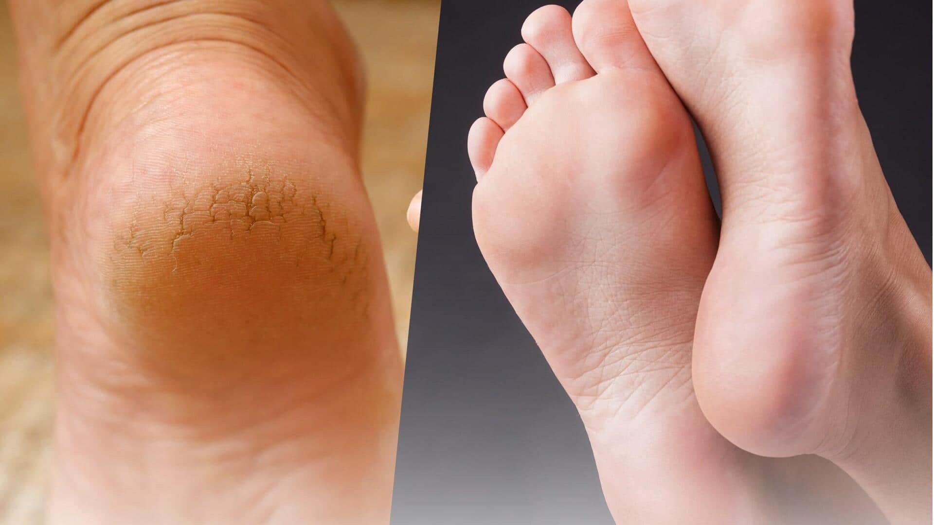 Rice flour for cracked heels? Here's the truth