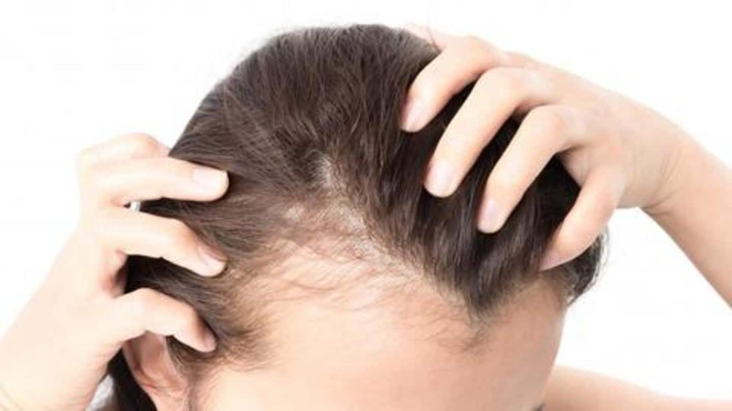 What is Alopecia, the medical-condition 'Gone Kesh' is based on