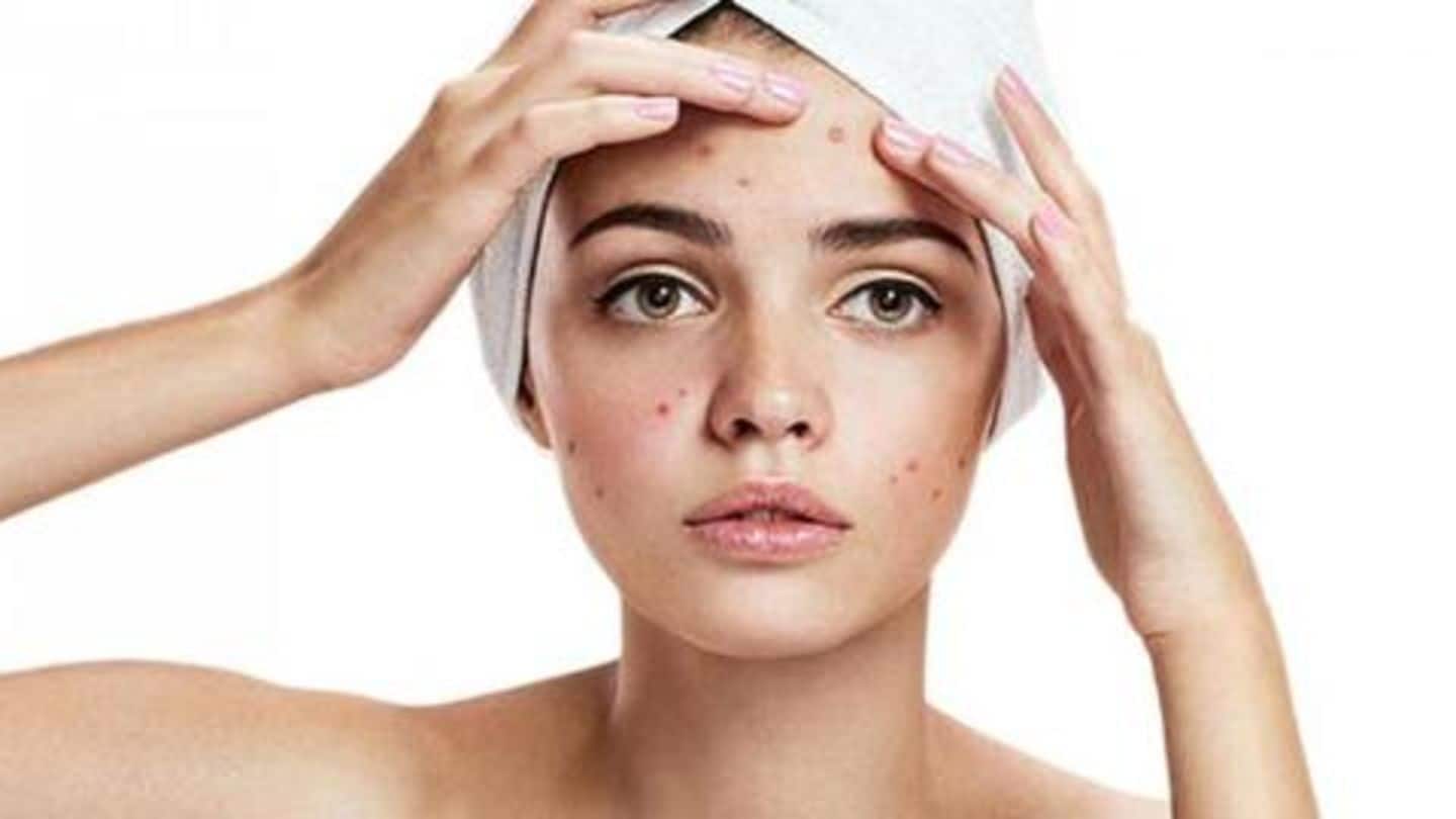 #HealthBytes: Five effective ways to fight acne in summer