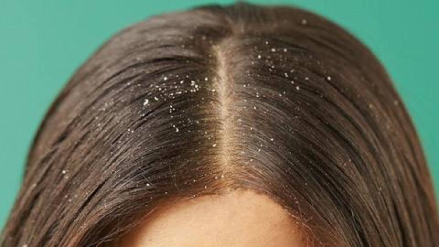 #HealthBytes: Five home remedies to get rid of dandruff naturally