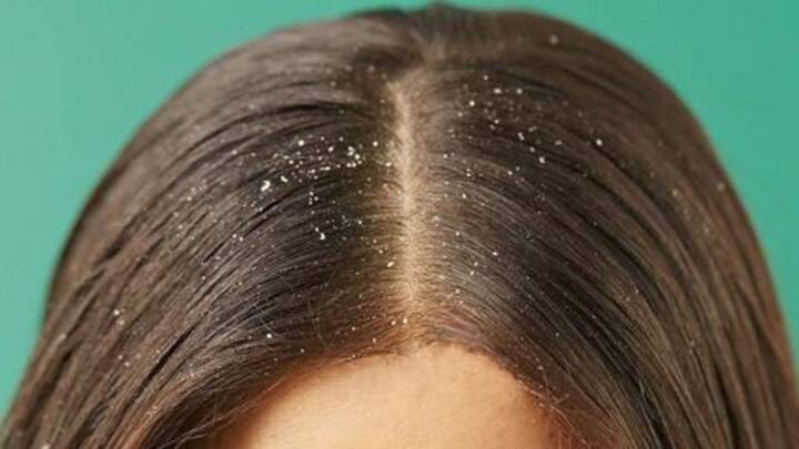 HealthBytes: Five home remedies to get rid of dandruff naturally
