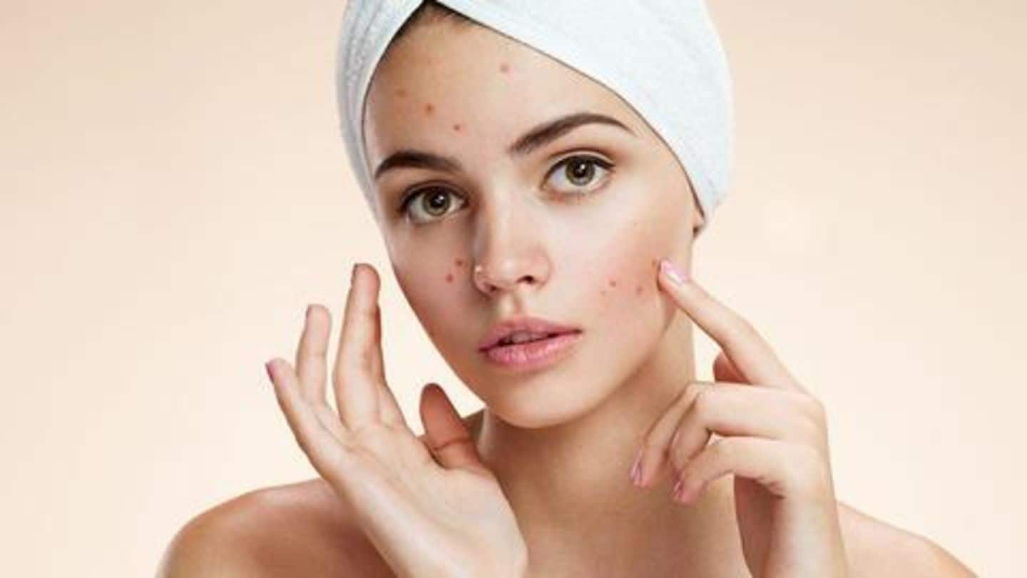 Postpartum acne: What it is and how to treat