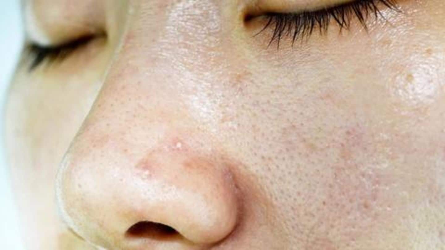 #HealthBytes: Top 6 home-remedies to get rid of oily skin