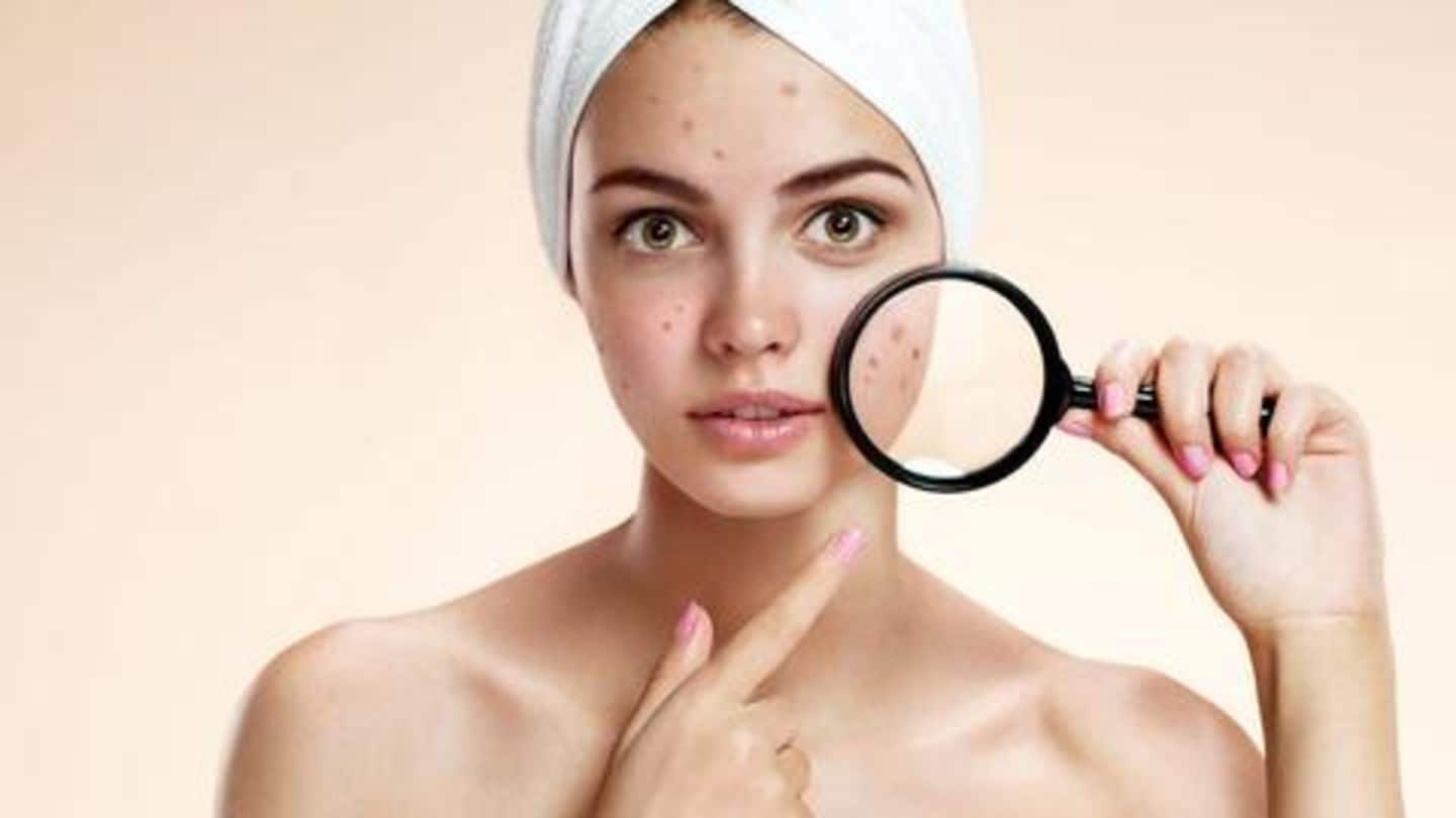 Acne in women: Causes, treatment, and home remedies