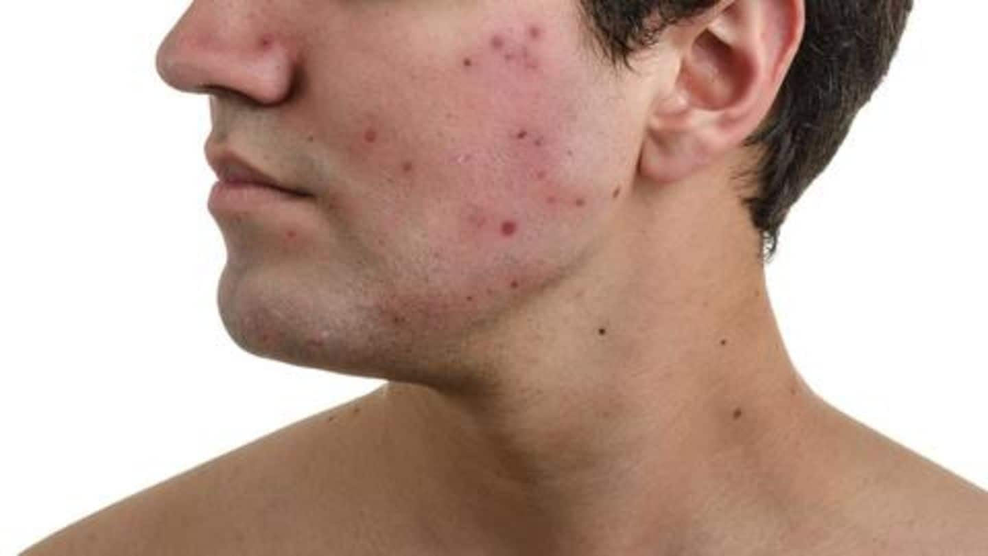 Acne in men: Causes, treatment, and home remedies