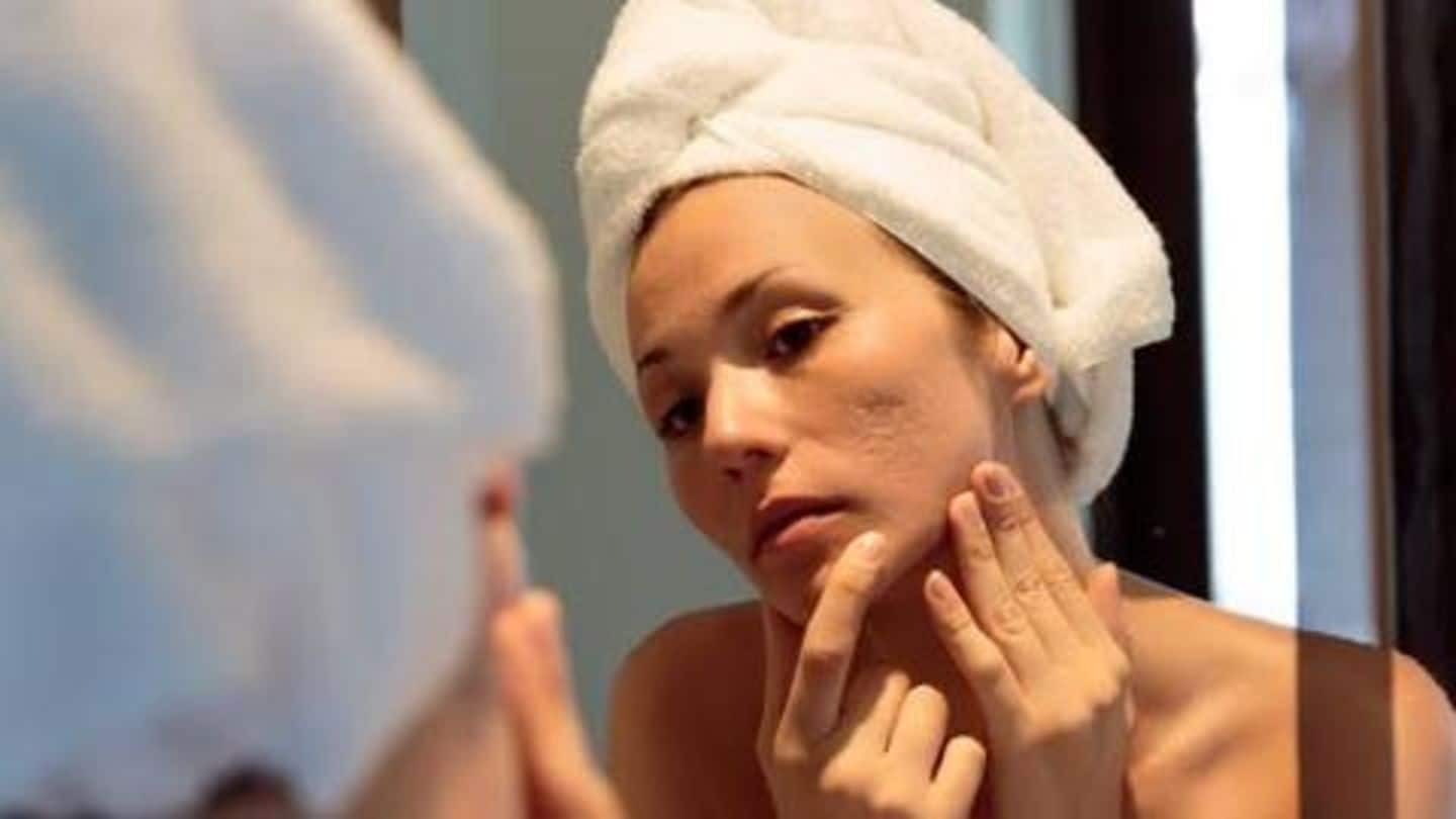What causes adult acne, and how to deal with it