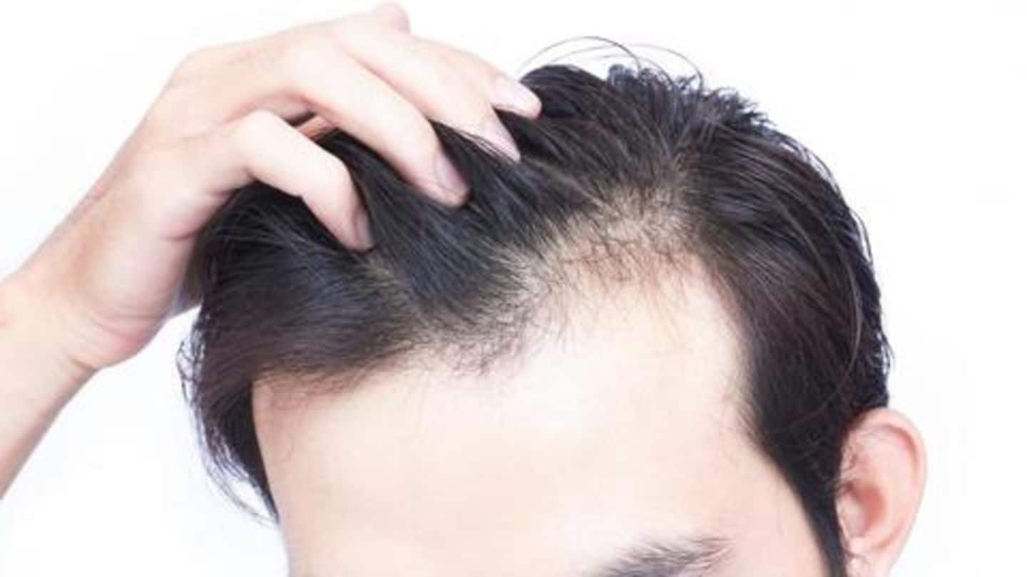 Hair loss: Causes, prevention and treatment