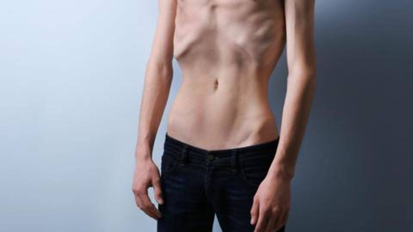 Anorexia nervosa Anorexia nervosa