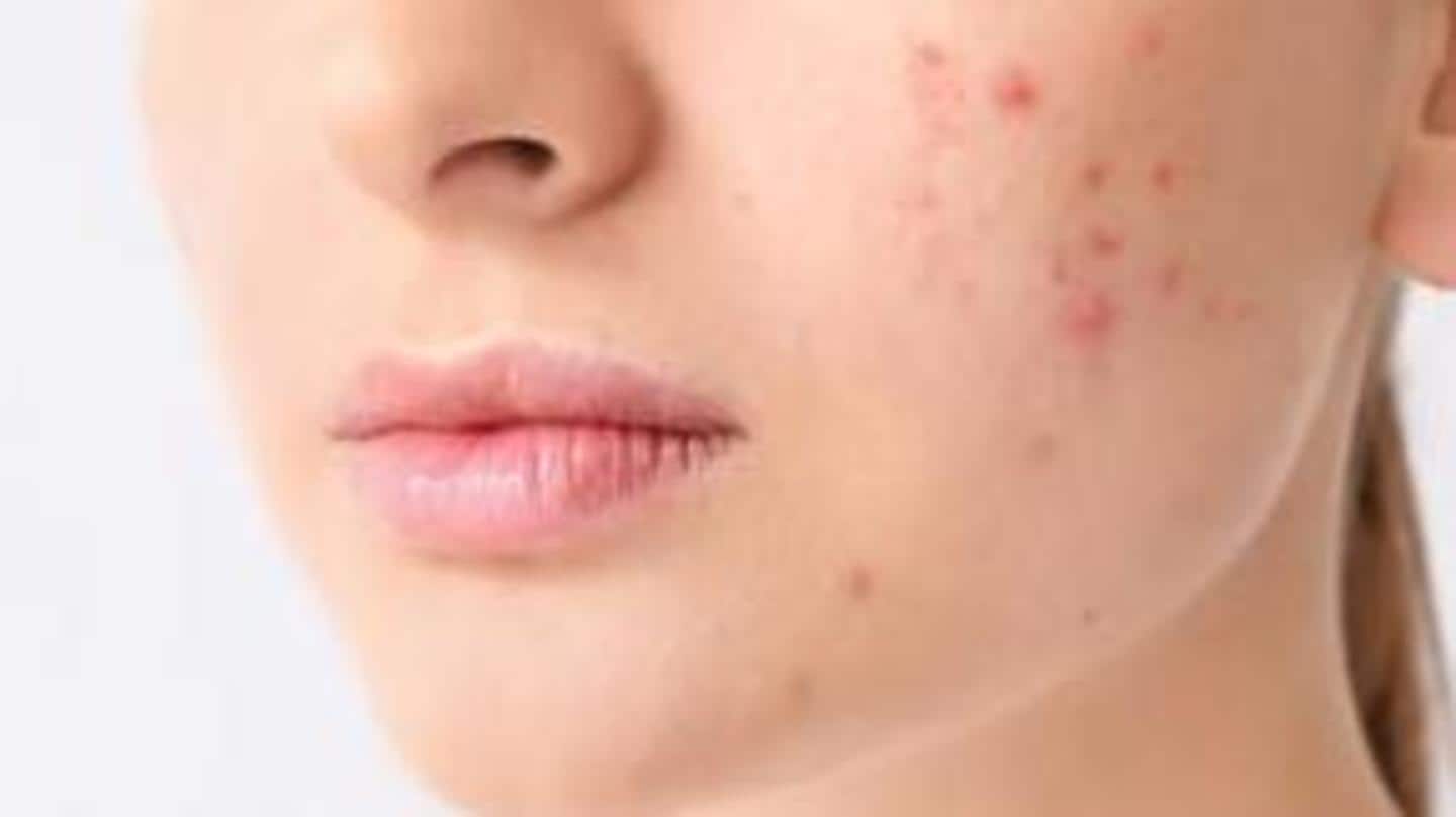 It clears clogged pores, reduces acne, addresses root cause It clears clogged pores, reduces acne, addresses root cause
