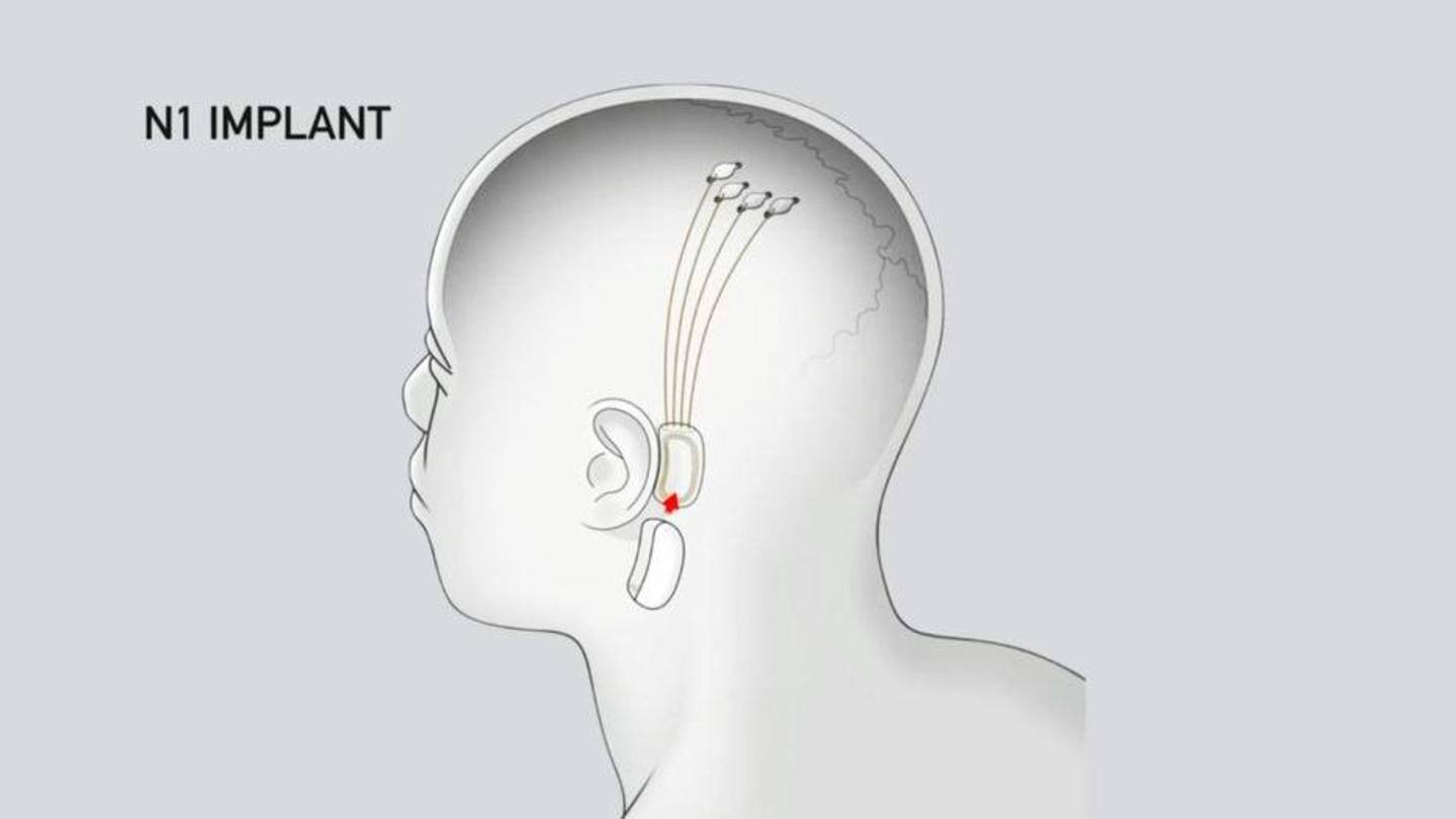 Back then, Neuralink had unveiled threads for man-machine link Back then, Neuralink had unveiled threads for man-machine link