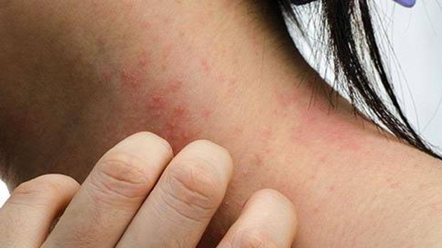Contact dermatitis can cause red rashes Contact dermatitis can cause red rashes