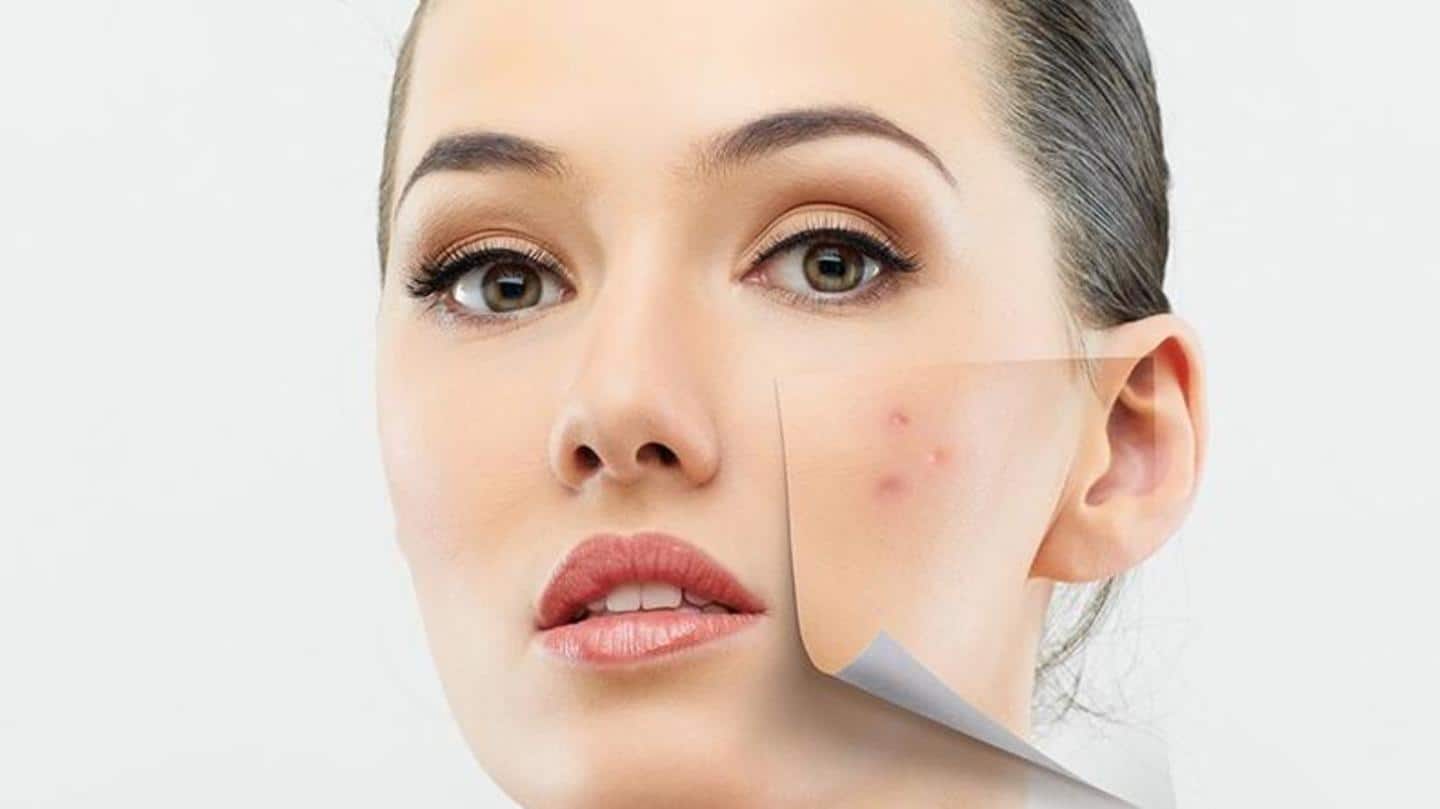 Here are some quick and easy home remedies for acne