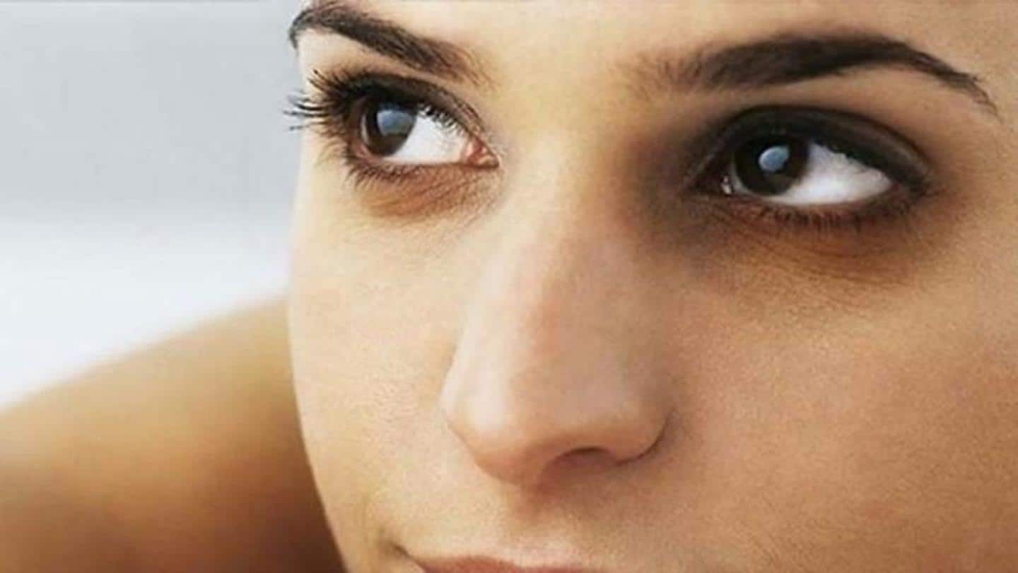 #HealthBytes: How to treat dark circles under the eyes