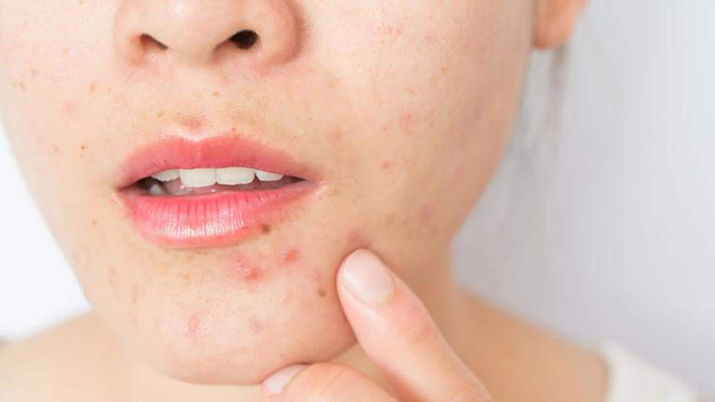 Common habits that can make acne scars worse