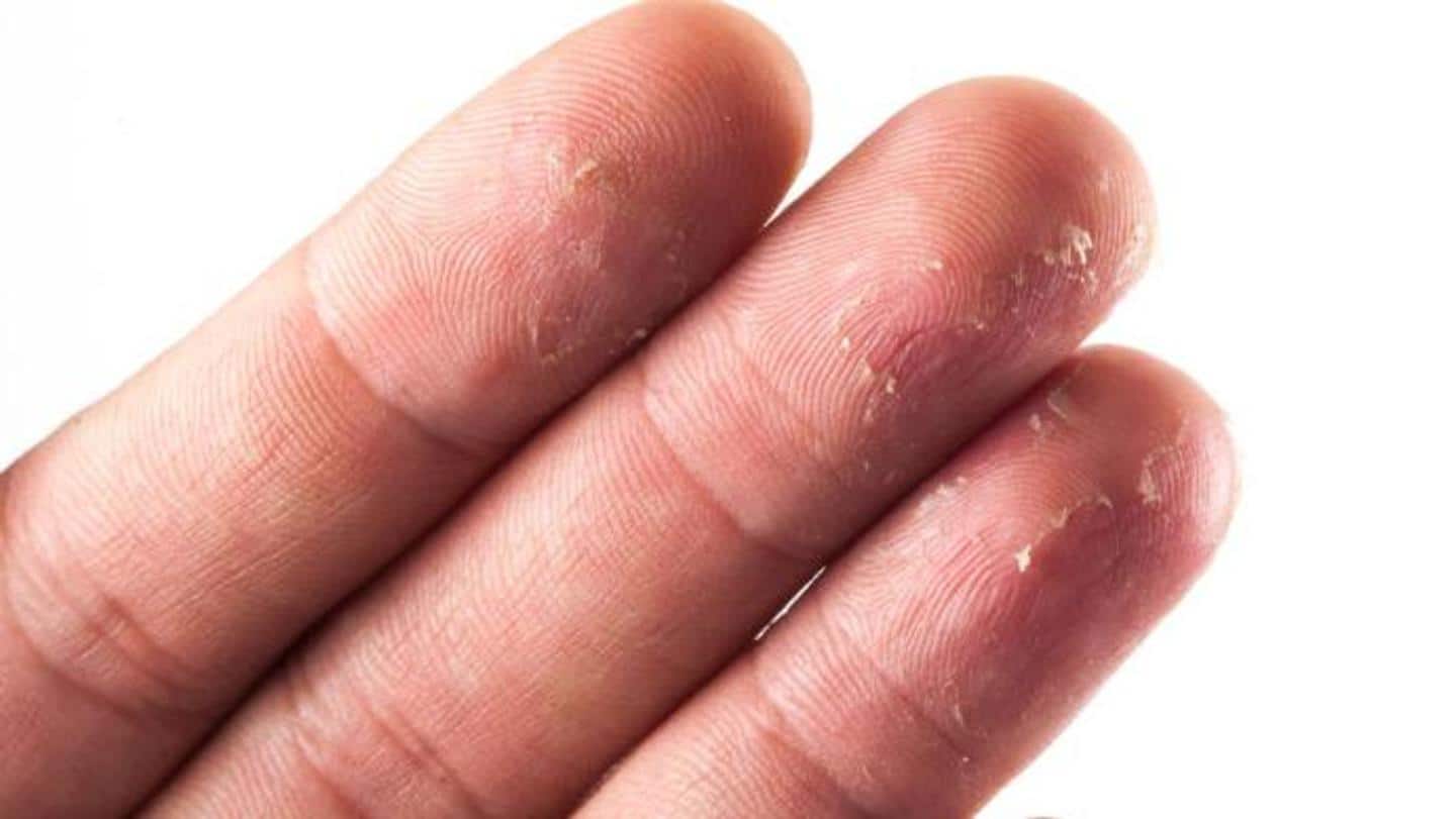 #HealthBytes: Home remedies for removing peeling skin from fingertips