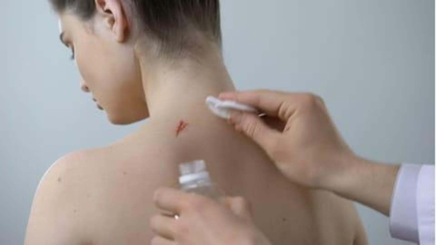 Some remedies to try at home to remove scars NewsBytes