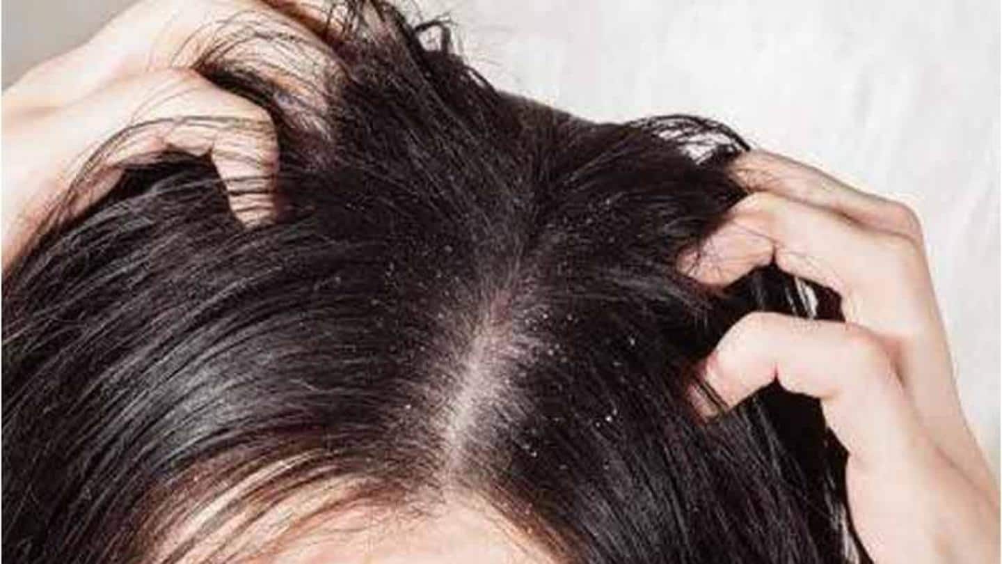 Manage dandruff with correct products and home remedies Manage dandruff with correct products and home remedies