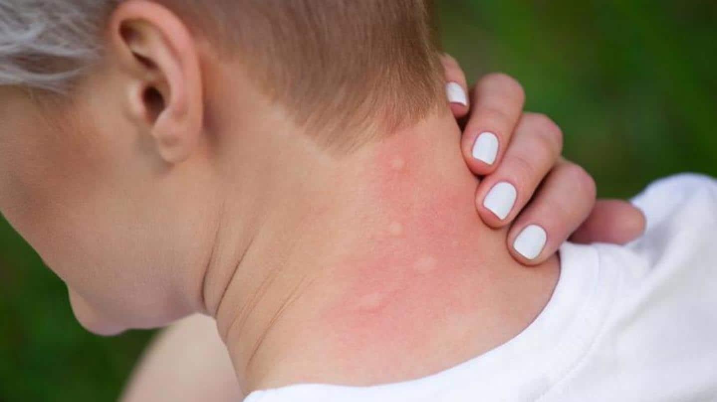 Home remedies for treating mosquito bites