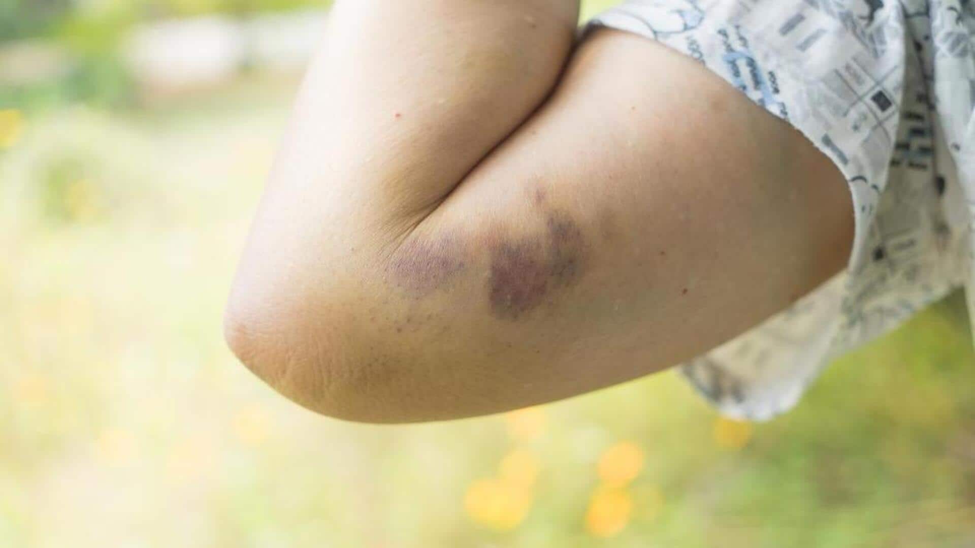 These home remedies may bring relief to forearm bruises