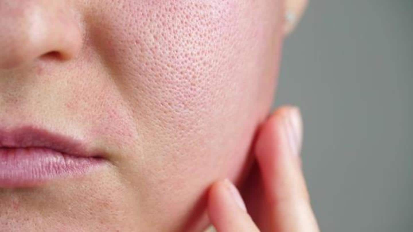 Have large pores on the skin? These remedies can help