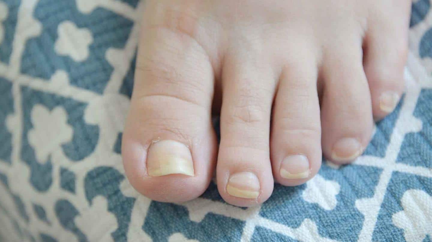 Few common nail conditions and remedies to fix them | NewsBytes