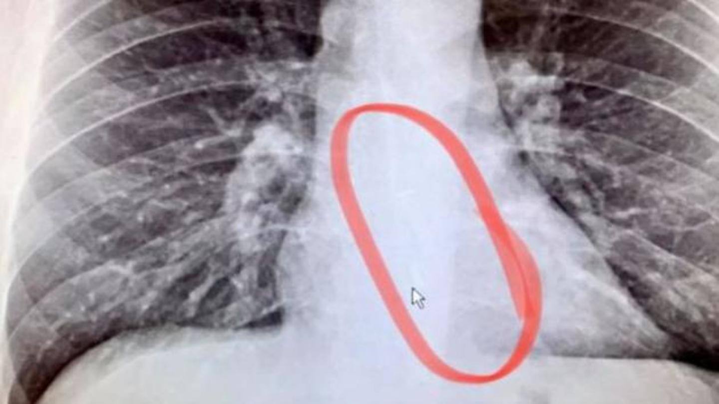 Family jocularly suggested he might have swallowed the missing AirPod Family jocularly suggested he might have swallowed the missing AirPod