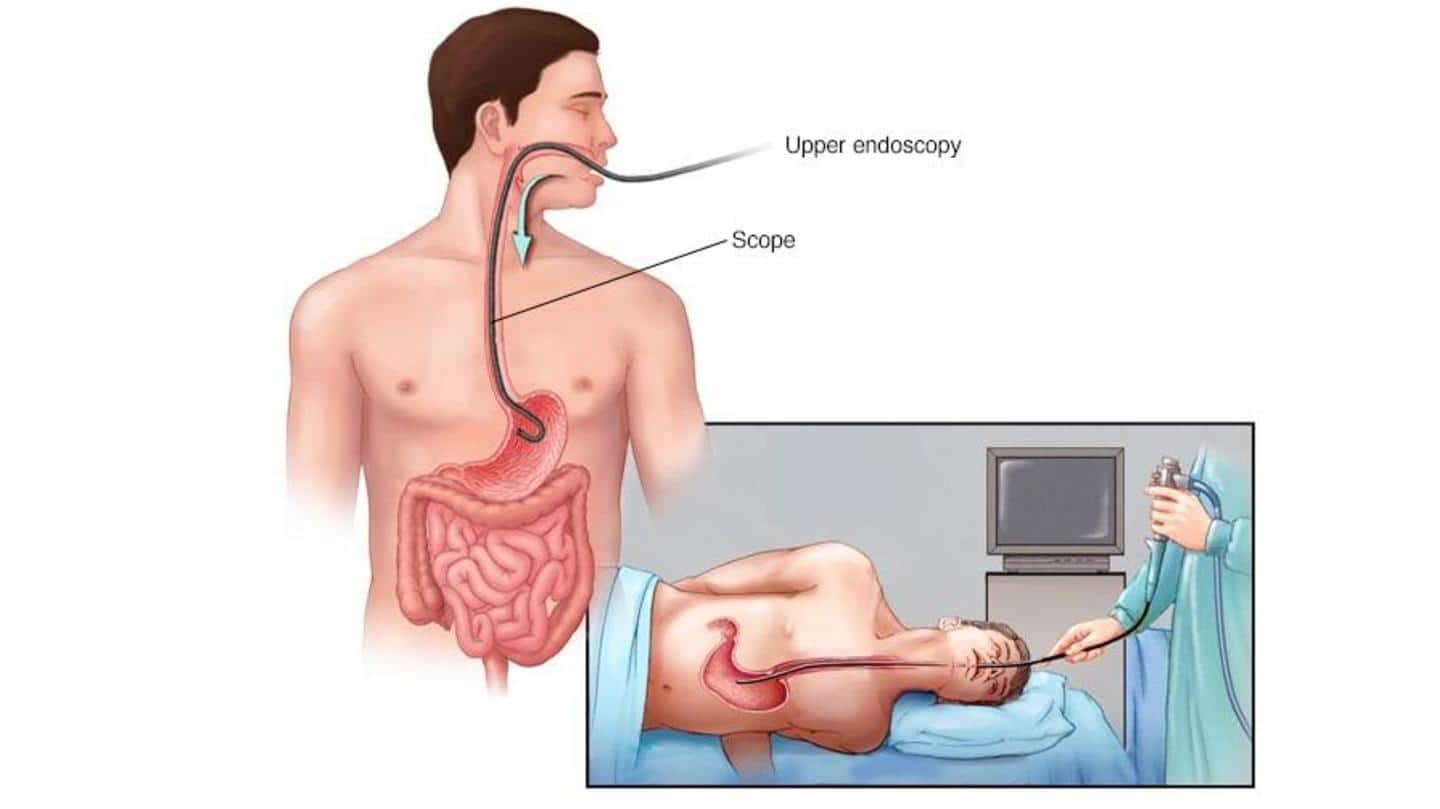 ER performed emergency endoscopy to remove the AirPod ER performed emergency endoscopy to remove the AirPod