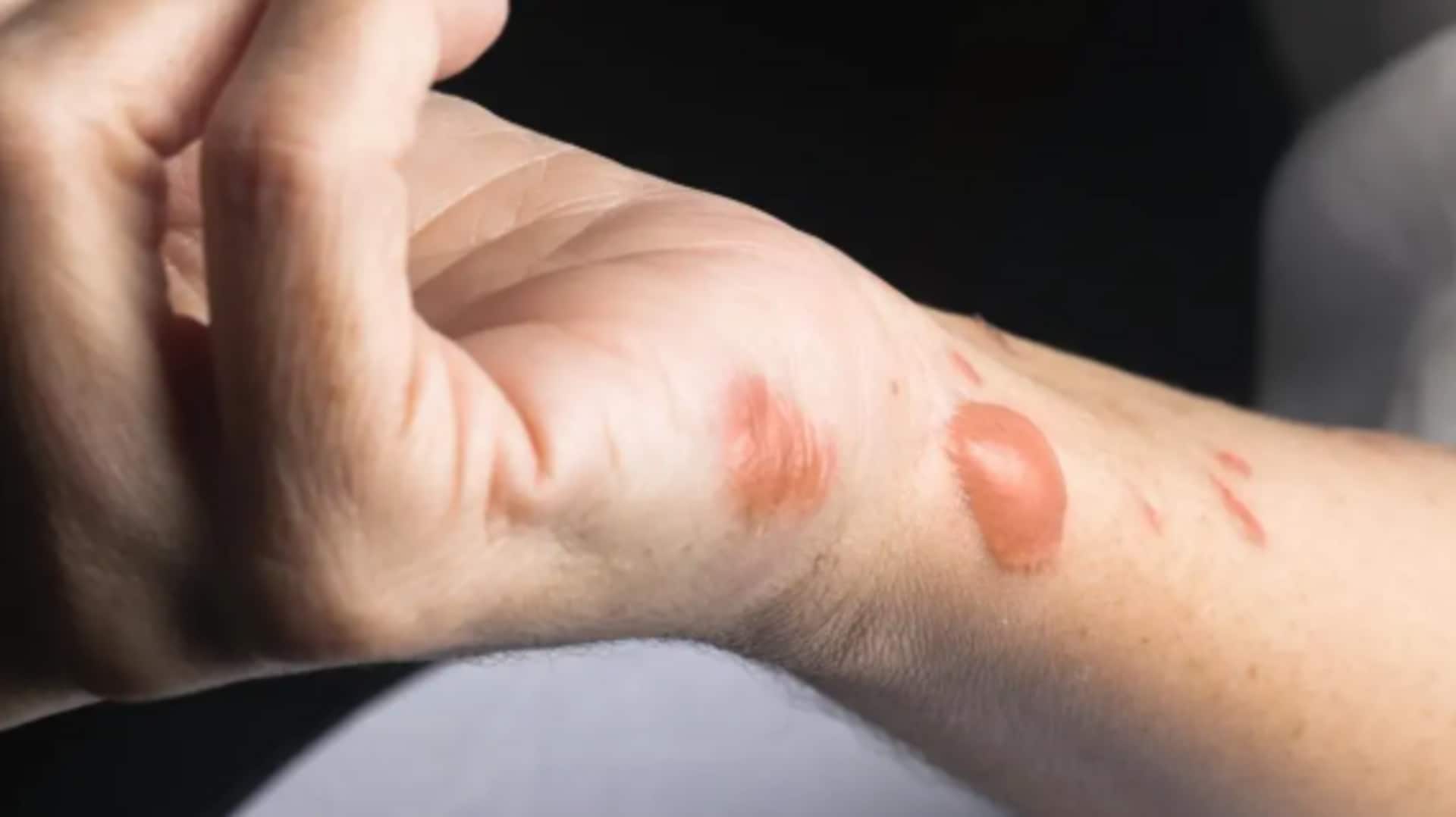  Fix minor burns with these home remedies