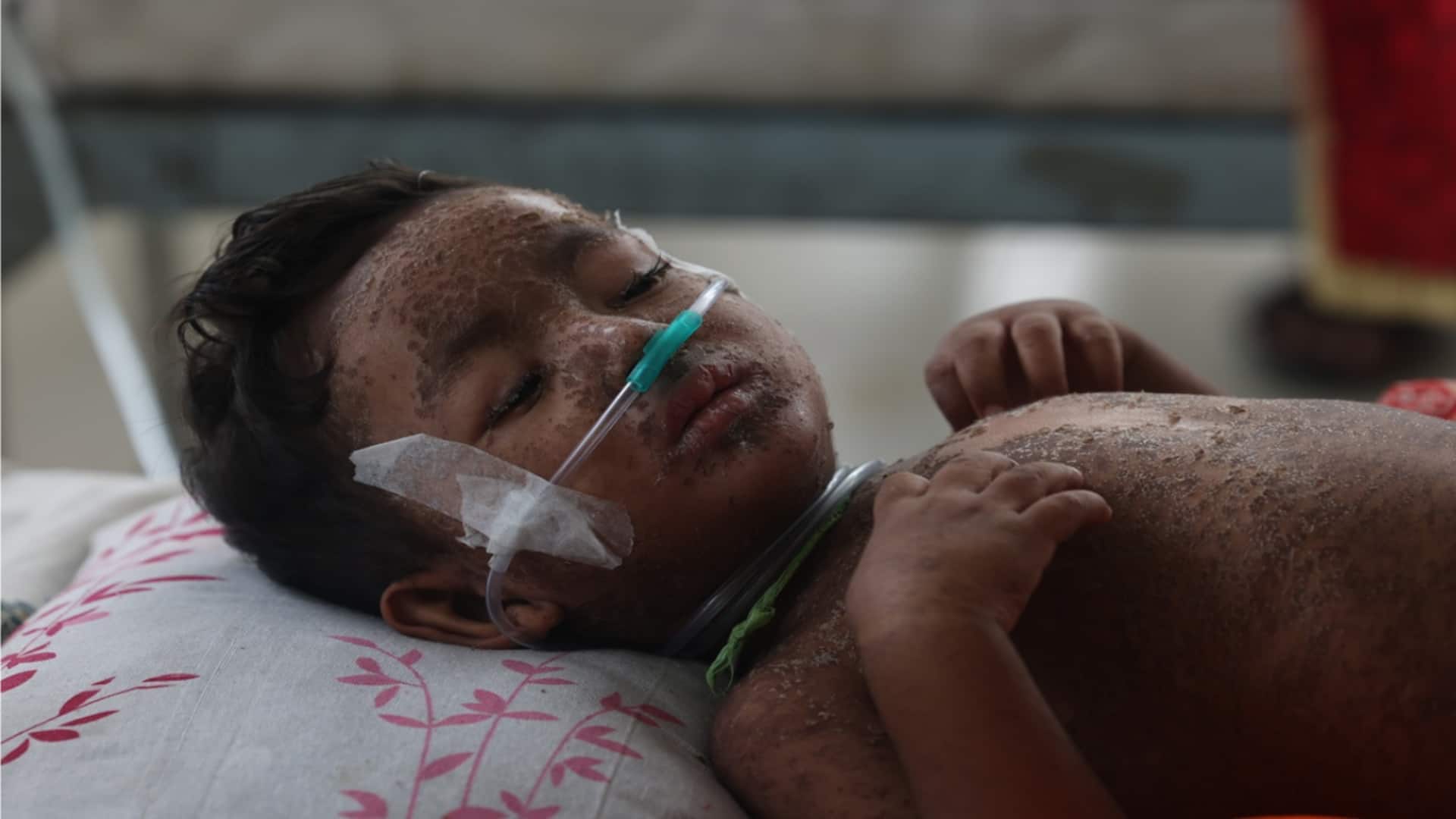 Measles outbreak in Bangladesh: Death toll exceeds 300