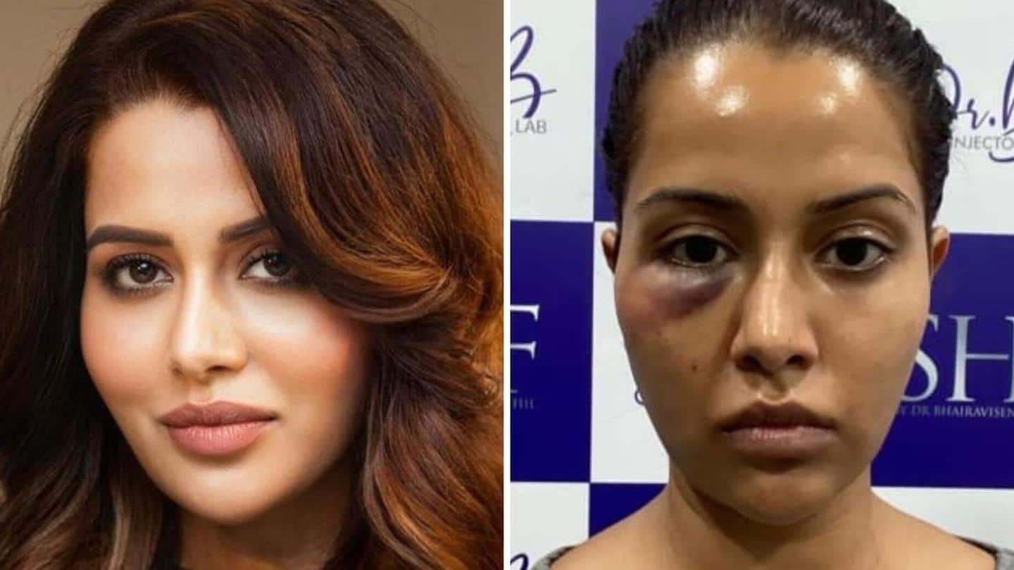 Actress blasts doctor after dermatological process leaves her with swelling