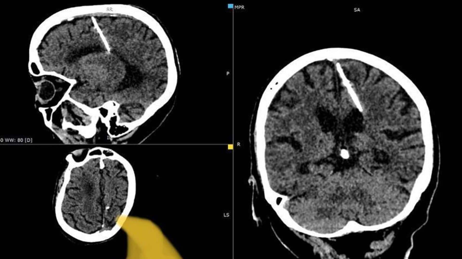 80-year-old Russian woman has been living with needle in brain