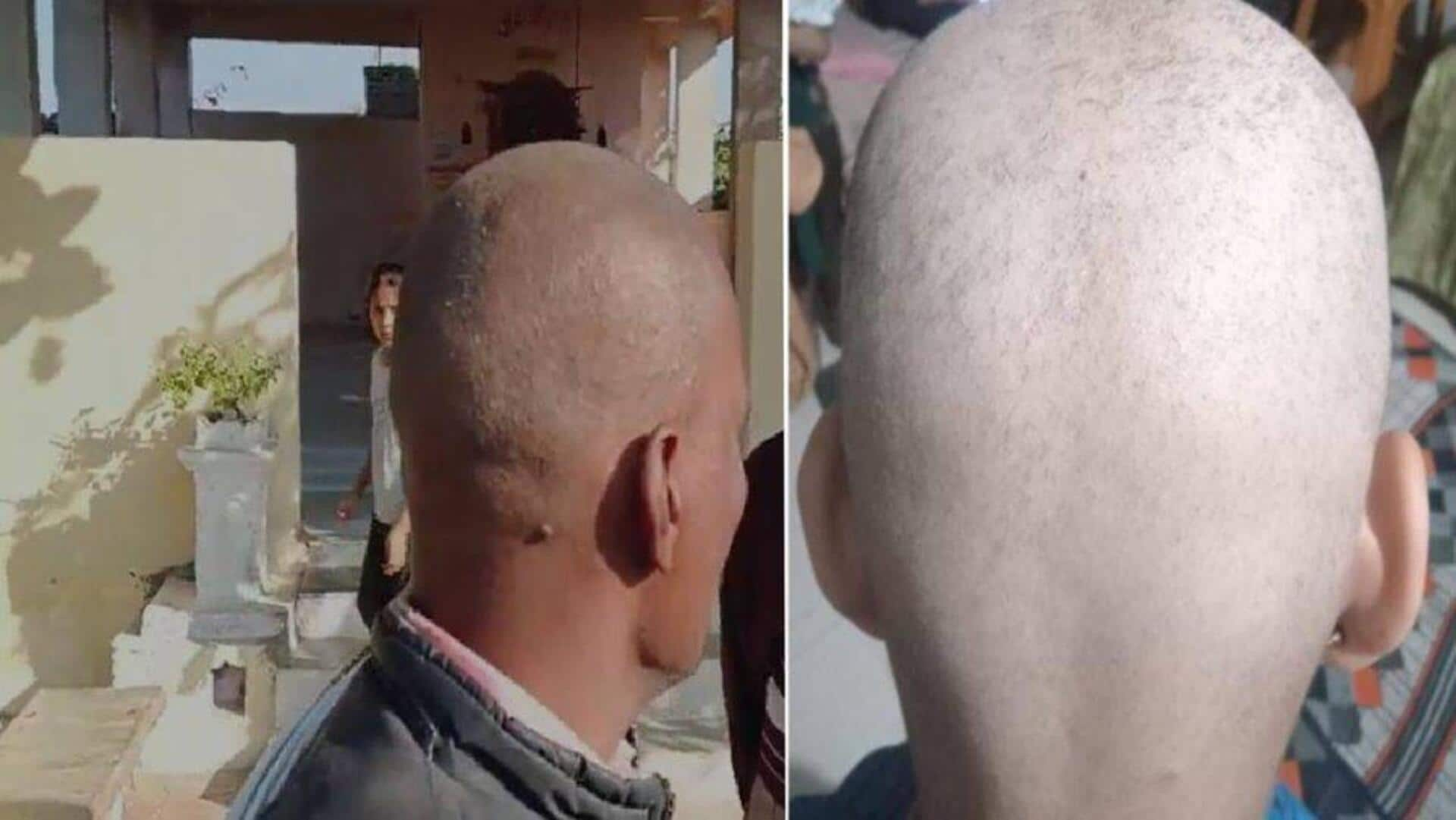 Sudden hair loss, baldness in 3 Maharashtra villages spark panic 