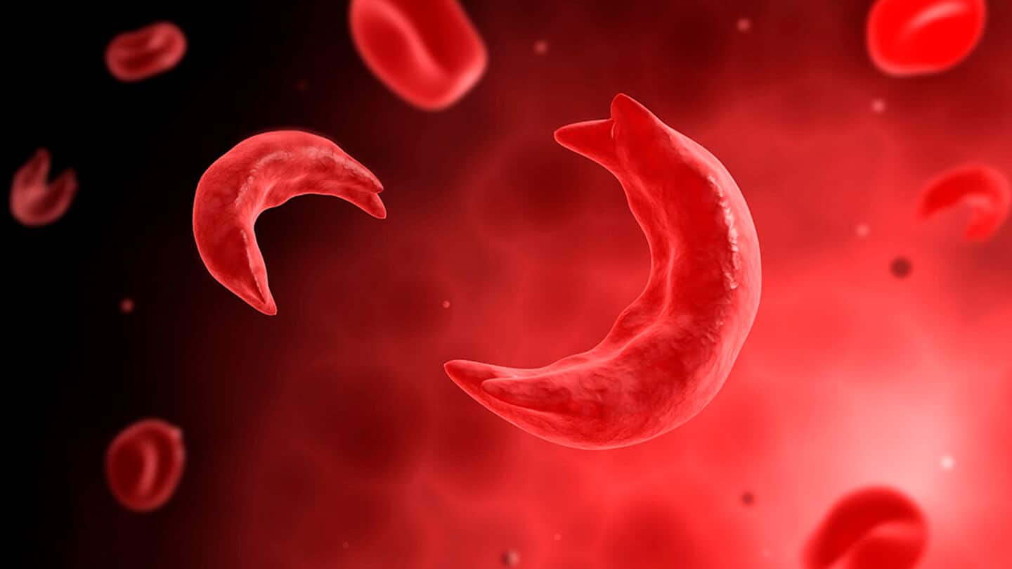 Modi government to screen 70M people for sickle cell disease Modi government to screen 70M people for sickle cell disease