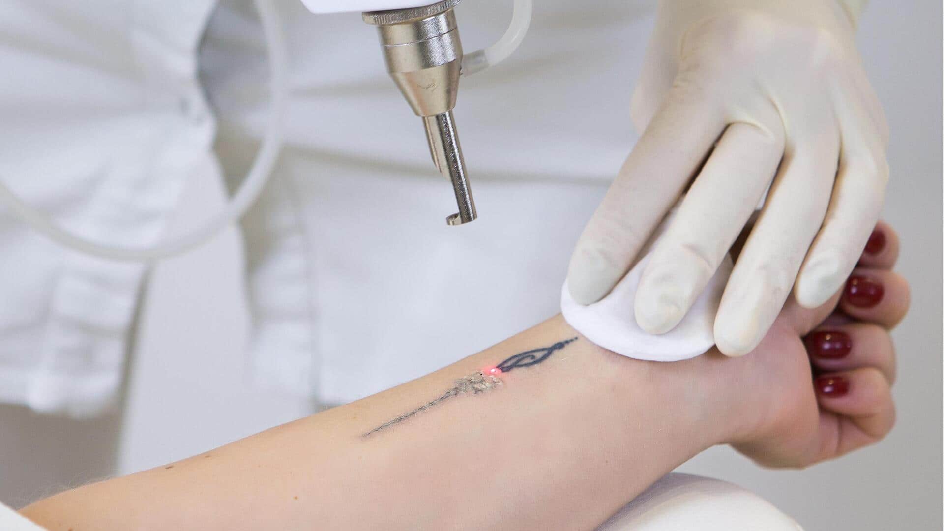 Your handbook to tattoo removal methods 
