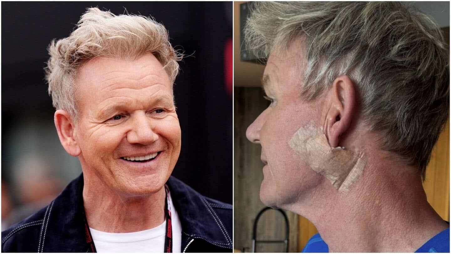 What's basal cell carcinoma? Gordon Ramsay undergoes skin cancer surgery What's basal cell carcinoma? Gordon Ramsay undergoes skin cancer surgery