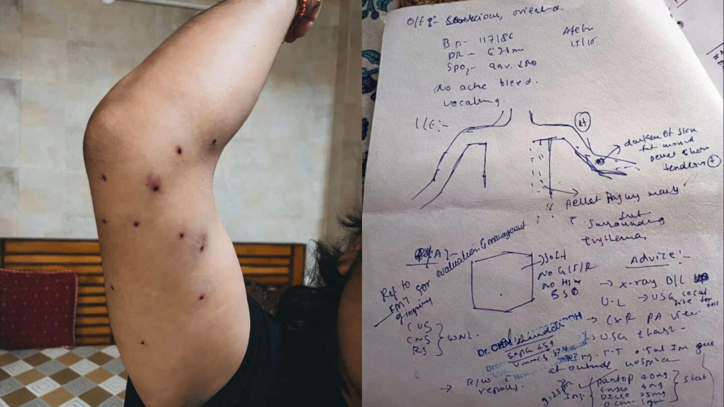 Delhi Police say pellets not used; hospital report contradicts claim 