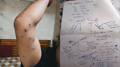 Delhi Police say pellets not used; hospital report contradicts claim 