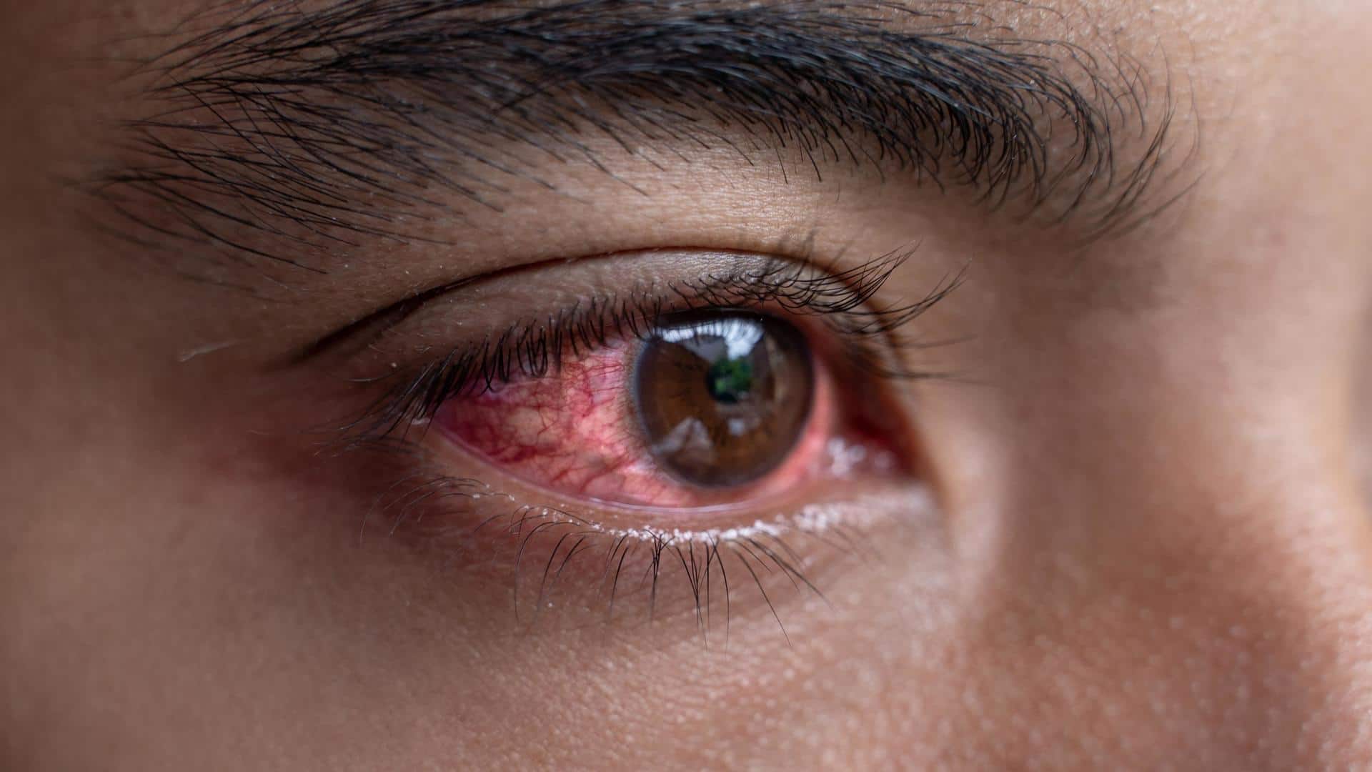 Conjunctivitis: Home remedies that can offer relief