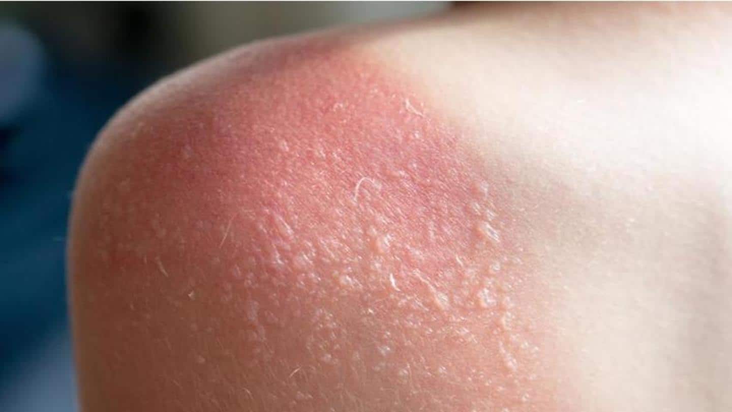 Sun Poisoning Heres Everything On The Severe Form Of Sunburn Newsbytes