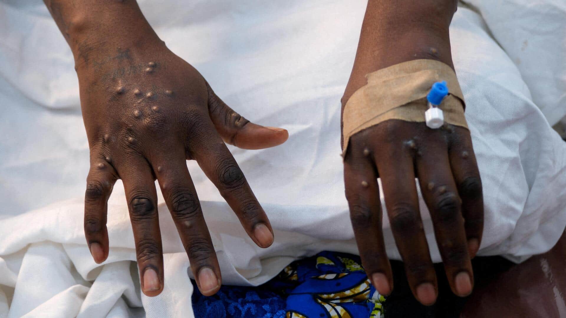 Ethiopia confirms deadly Marburg virus outbreak: Know symptoms and risks