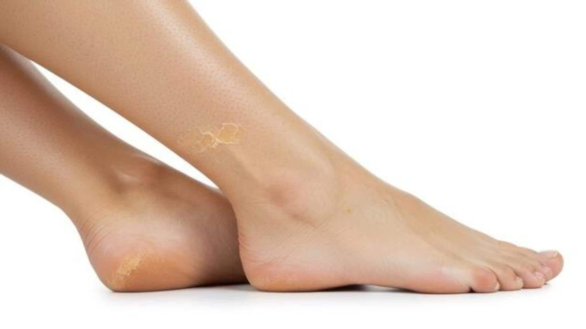 What really causes cracked heels? 
