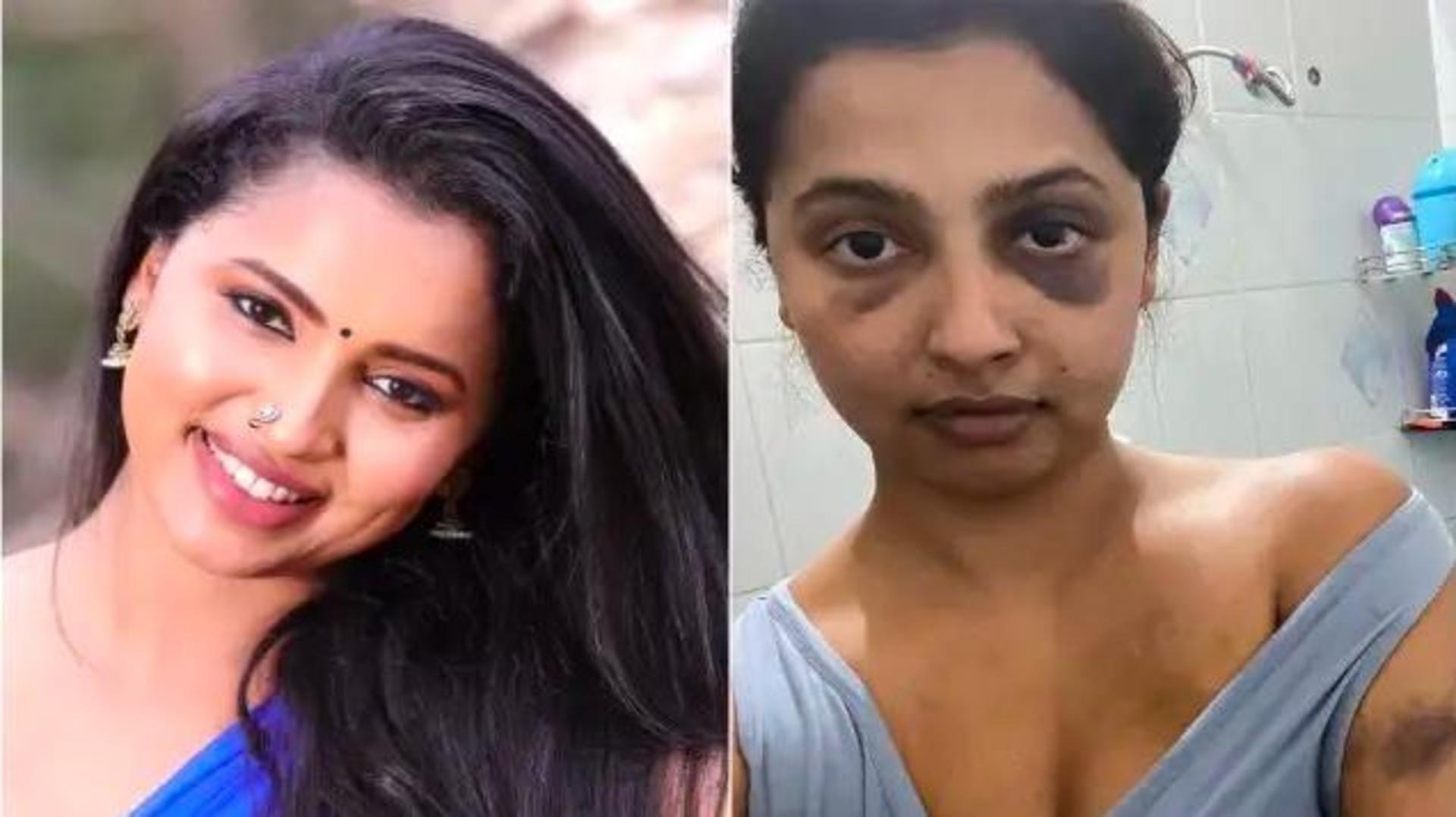 Tamil actor Anicka accuses ex-boyfriend of assault, shares disturbing pictures