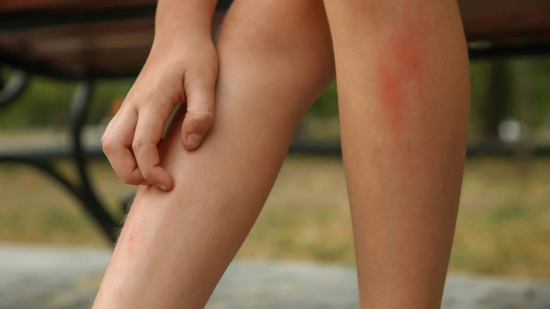 Fix mild shin irritation with these home remedies 