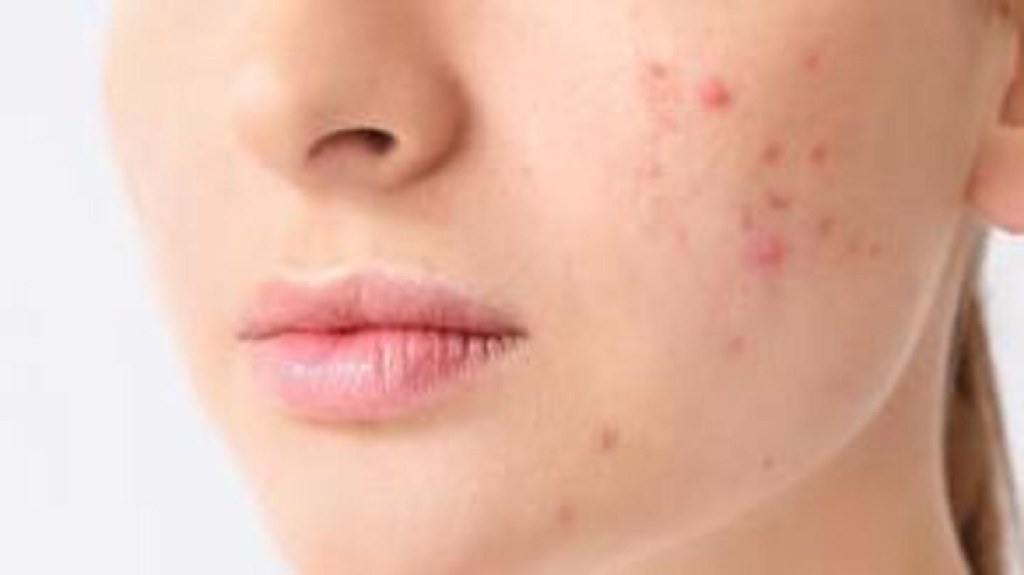 Strawberry and honey mask helps in reducing acne Strawberry and honey mask helps in reducing acne