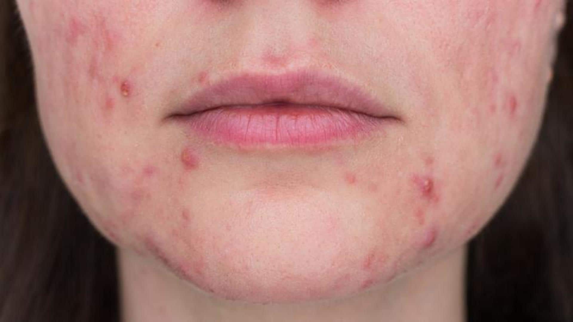 Papulopustular rosacea: Causes, symptoms, and prevention 
