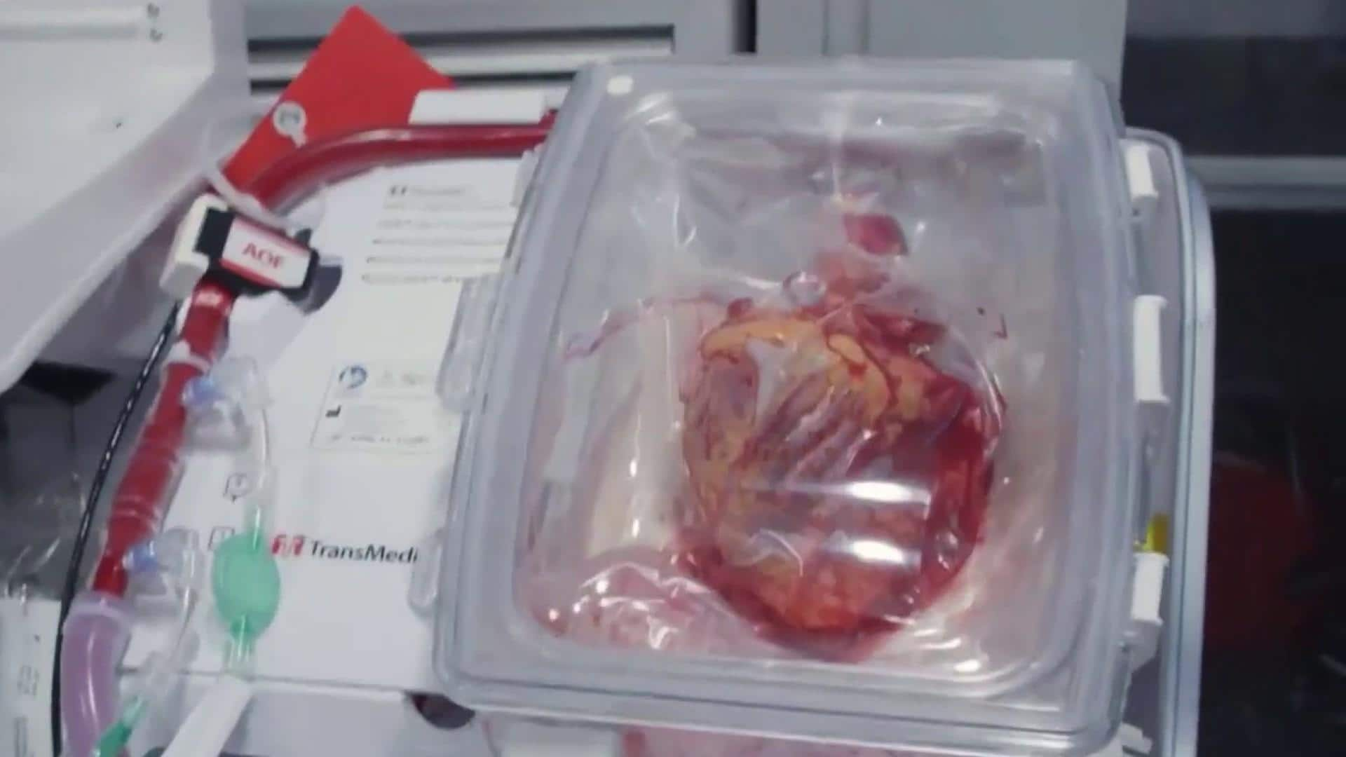 Breakthrough device keeps donor hearts beating for 9 hours